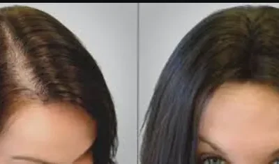 Injerto de pelo: Recupera confianza y bienestar